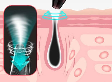 Visual Blackhead Acne Remover